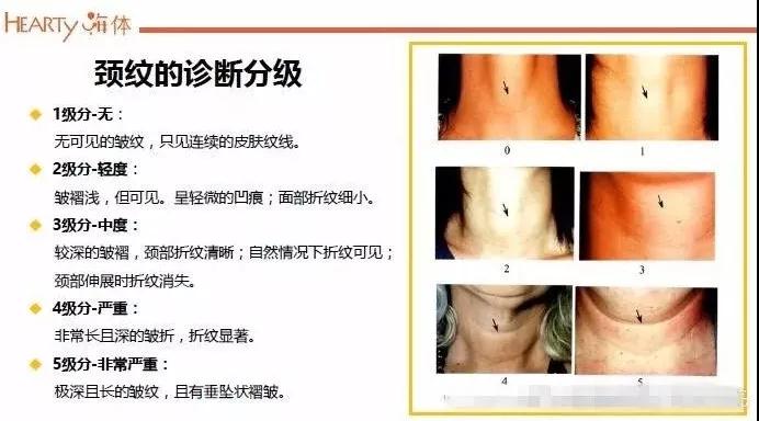 深圳非凡嗨体不仅用于火鸡脖祛颈纹效果好，还可填充泪沟