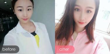 深圳阳光是公立三甲医院吗?整形怎么样?会失败吗?附阳光真人整形案例_价格表