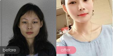 深圳美莱陈磊双眼皮整形技术怎么样?听说陈磊是韩国练习生指定手术医生?