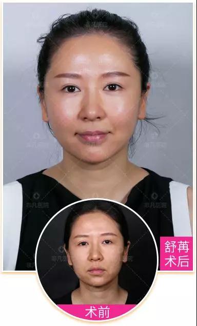 深圳做线雕去哪家医院?非凡线雕提升让你若干年以后，看起来依然像当年的样子