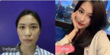深圳非凡梅够明做鼻子好不?梅够明个性化定制美鼻让你整张脸都变的好看有气质