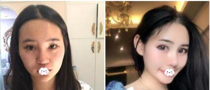 广州广美美莱华美哪个好?医院资质、医生案例、价格综合比较