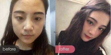 广州广美美莱华美哪个好?医院资质、医生案例、价格综合比较