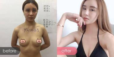 广州广美美莱华美哪个好?医院资质、医生案例、价格综合比较