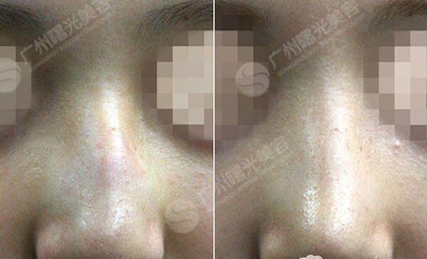 广州曙光程鹏主任整形技术怎么样?程鹏擅长项目_手术风格_隆鼻案例效果