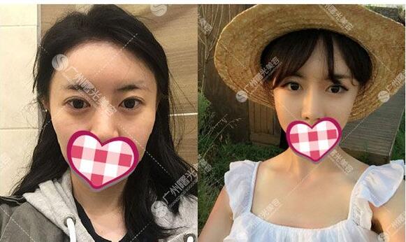 广州曙光程鹏主任整形技术怎么样?程鹏擅长项目_手术风格_隆鼻案例效果