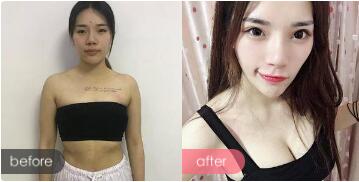 辽宁沈阳协和是正规医院?整形靠谱不?医生主治项目_双眼皮、线雕、切胸案例