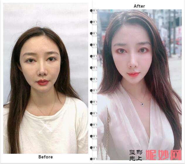 深圳哪儿做美国欣美极FLX（五代热玛吉）效果好？非凡热玛吉案例_价格