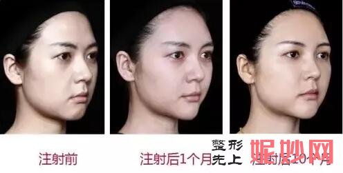深圳非凡铂金瑞蓝玻尿酸只需3800元，就可像具惠善一样拥有一张童颜
