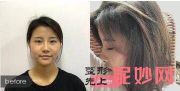 北京黄寺整形外科张旭东医术水平怎么样?张旭东门诊排号方式_鼻整形案例_价格表