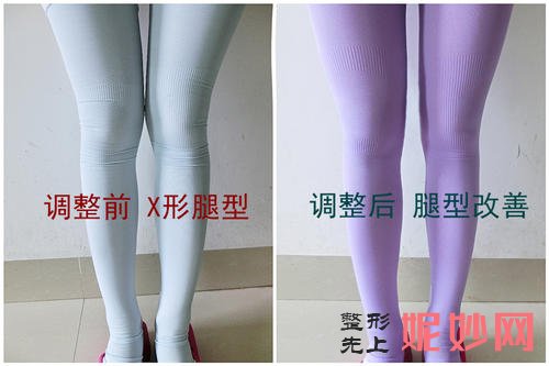北京禾丽康OX型腿美学艺术矫正术改善腿部形态缺陷操作方法_案例效果