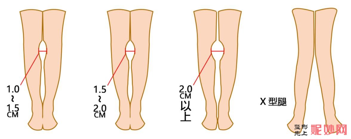 北京禾丽康OX型腿美学艺术矫正术改善腿部形态缺陷操作方法_案例效果