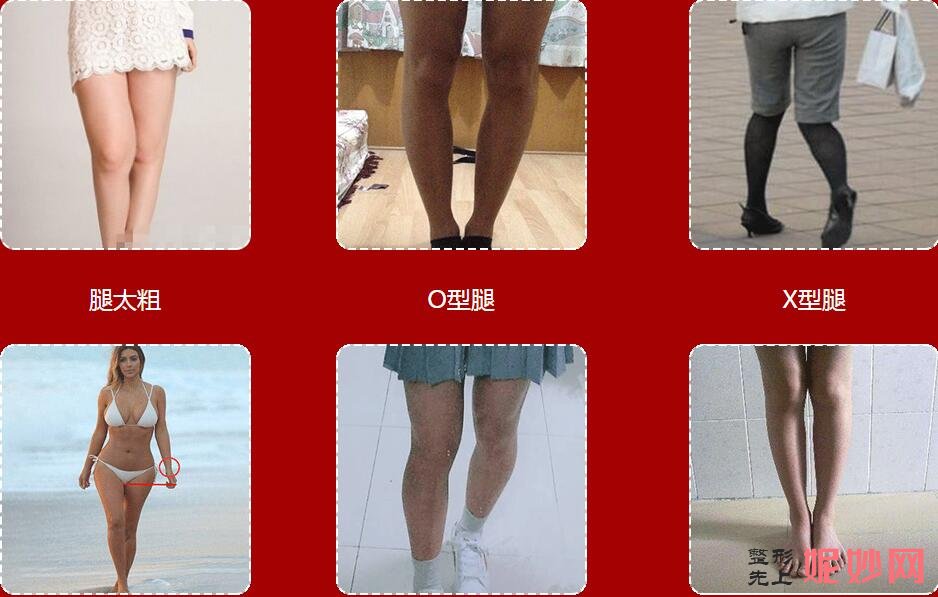 OX型粗短腿这么简单就矫正了?北京艺美王东院长通过腿部外在轮廓的改变实现腿部美丽塑形