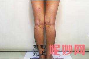 OX型粗短腿这么简单就矫正了?北京艺美王东院长通过腿部外在轮廓的改变实现腿部美丽塑形