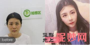 北京柏丽李劲良鼻综合整形前后对比图