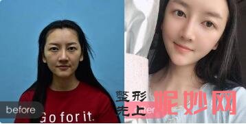 北京禾美嘉、上上相、清木、玉之光、东方和谐、联合丽格擅长脂肪填充出名的医生及案例效果