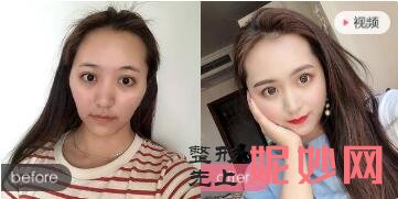 北京禾美嘉是公立的权威抽脂医院吗?禾美嘉任学会吸脂填充手案例及求美者真实评价?