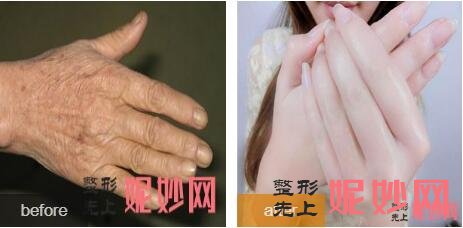 北京禾美嘉是公立的权威抽脂医院吗?禾美嘉任学会吸脂填充手案例及求美者真实评价?