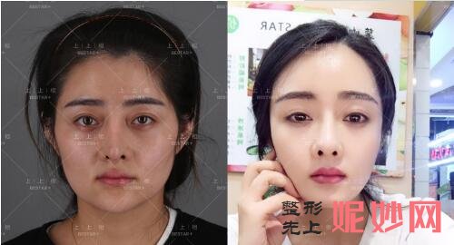 北京禾美嘉、上上相、清木、玉之光、东方和谐、联合丽格擅长脂肪填充出名的医生及案例效果