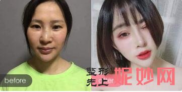北京华韩医院谢立宁、禾美嘉医院任学会谁抽脂填充手效果好?
