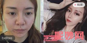 北京上上相郑楚蓉(原名郑冬青)和黄罡、候月华谁更擅长脂肪填充手术?口碑效果好不好?
