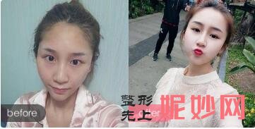 北京上上相郑楚蓉(原名郑冬青)和黄罡、候月华谁更擅长脂肪填充手术?口碑效果好不好?