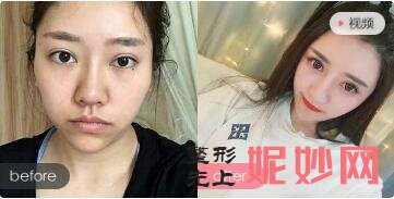 北京清木马梅生院长面部吸脂填充技术怎么样?会下垂松弛吗?马梅生面填安全附真人手术案例