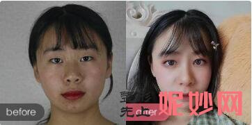 北京玉之光整形技术怎么样?会做毁失败吗?玉之光案例效果_真实评价_价格表