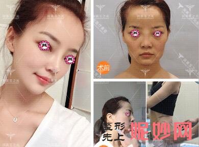 北京禾美嘉、上上相、清木、玉之光、东方和谐、联合丽格擅长脂肪填充出名的医生及案例效果