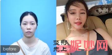 北京禾美嘉、上上相、清木、玉之光、东方和谐、联合丽格擅长脂肪填充出名的医生及案例效果