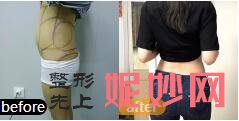 北京东方和谐零血水抽脂靠谱吗?有没有出过医疗事故?北京东方和谐真人抽脂案例效果?