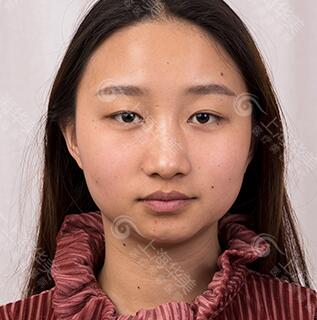 上海华美张朋隐形切开双眼皮效果怎么样?附较新双眼皮手术价格