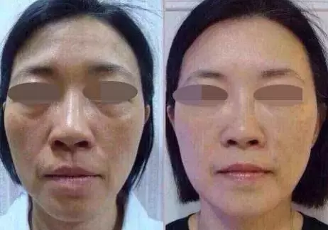 逆龄青春丨一次PPDO埋线提升 星宸整形让你的年纪成为秘密