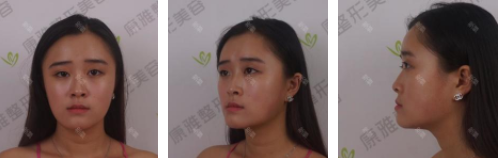 重庆康雅整形医院银山院长怎么样，真人双眼皮案例解密