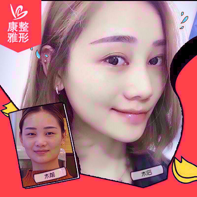 重庆康雅整形医院银山院长怎么样，真人双眼皮案例解密