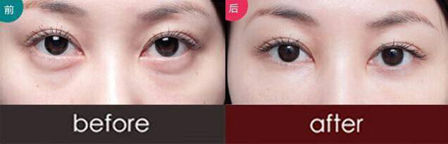 厦门欧菲整形医院：法令纹4D微雕，较适合现代人的美容方式