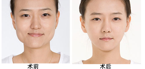磨骨和削骨的区别是什么?