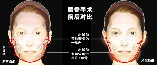 磨骨和削骨的区别是什么?