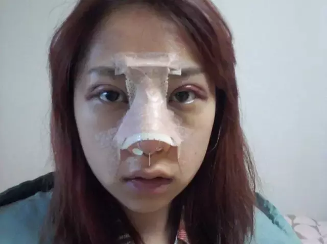 整鼻子有多少人后悔的?整完鼻子的感受