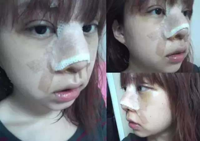 整鼻子有多少人后悔的?整完鼻子的感受