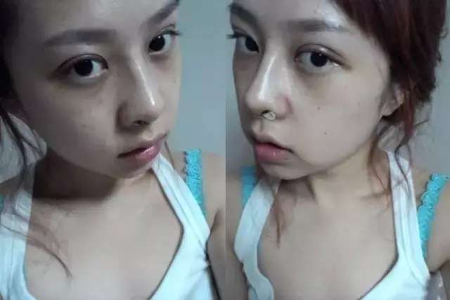 整鼻子有多少人后悔的?整完鼻子的感受