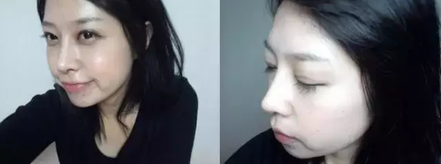 整鼻子有多少人后悔的?整完鼻子的感受