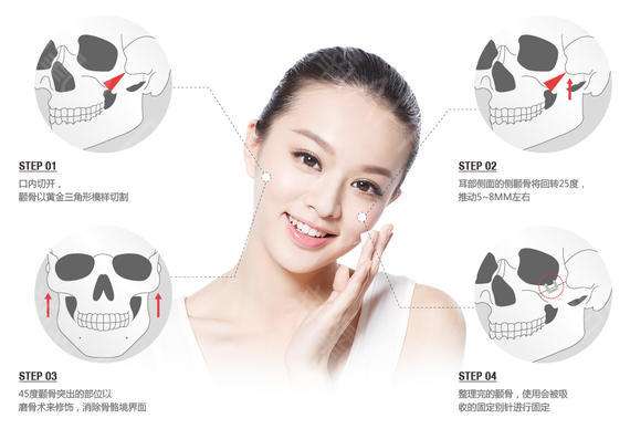 磨骨手术后遗症.危害