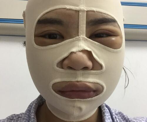 做完磨骨手术后的真实感受