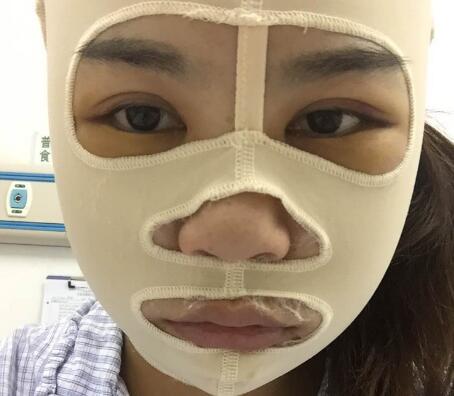 做完磨骨手术后的真实感受