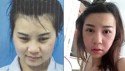 做完磨骨手术后的真实感受