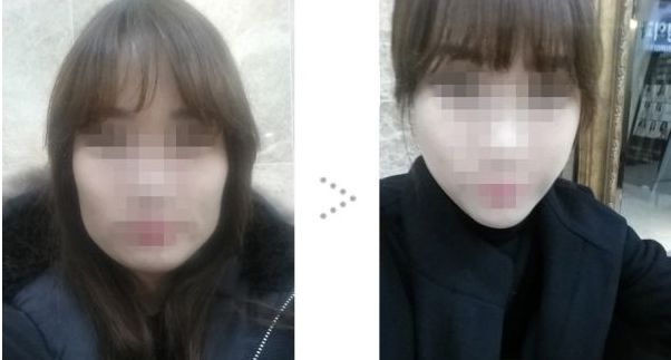 磨骨手术后如何护理脸部?