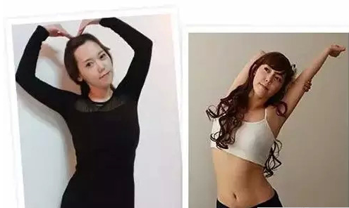 抽脂效果怎么样?吸脂减肥真人案例