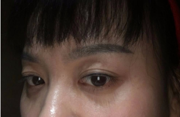纹眉后恢复自然需要多长时间?