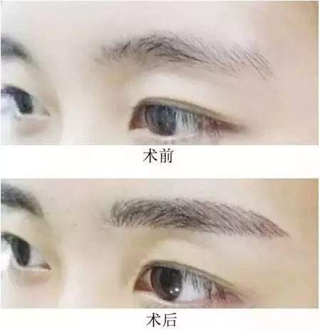 正规医院纹眉要多少钱?